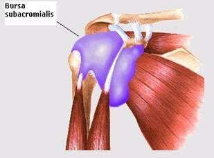 Schouderpijn bursitis