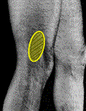 Hardloopblessures het tractus iliotibialis frictiesyndroom