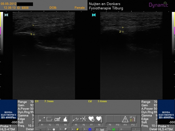 Fasciopathie plantaris 1 diagnose en echografie