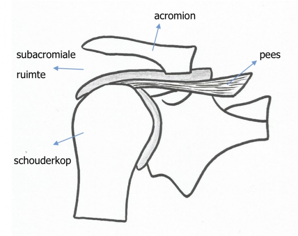 Schouderklachten 2 het subacromiaal pijnsyndroom saps