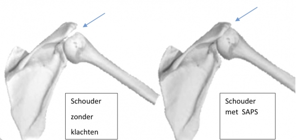Schouderklachten 3 het subacromiaal pijnsyndroom saps de behandeling