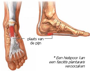 Hardloopblessures het hielspoor