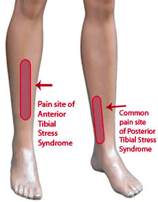 Hardloopblessures shin splints