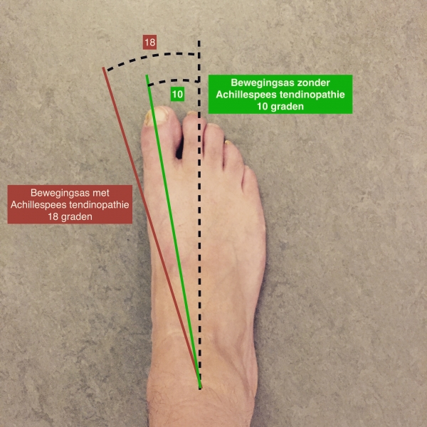 Achillespeesklachten je achilleshiel